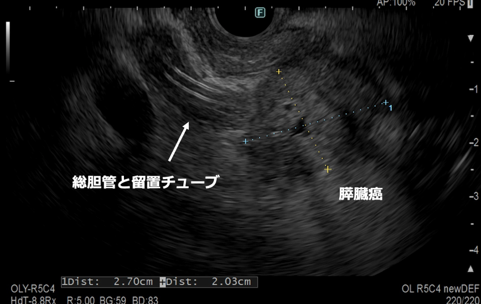 超音波内視鏡検査(EUS)について02